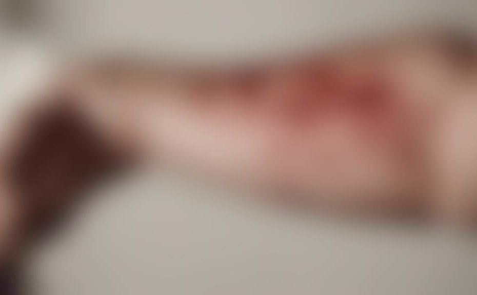 castor oil allergy symptoms